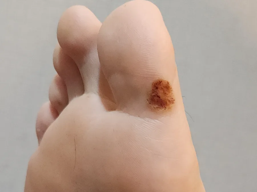 사마귀 치료 초기