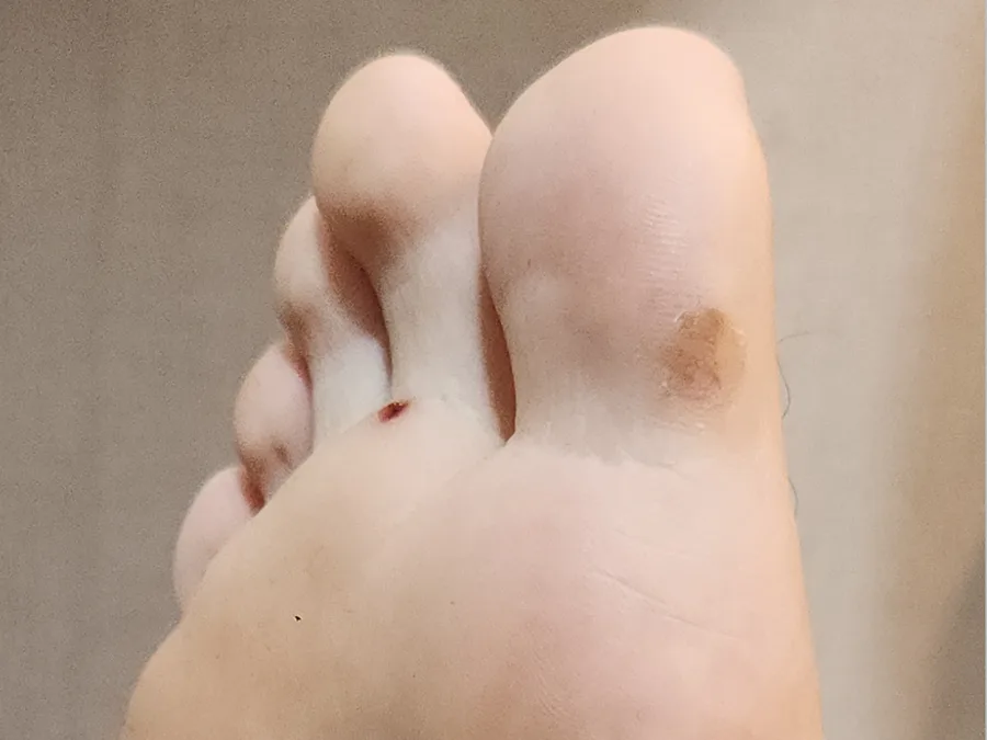 사마귀 치료 중기