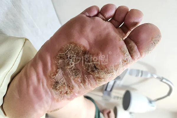 치료 전 발바닥 건선